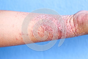 Atopic dermatitis AD, also known as atopic eczema, is a type of inflammation of the skin dermatitis.