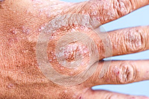 Atopic dermatitis AD, also known as atopic eczema, is a type of inflammation of the skin dermatitis.