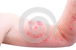 Atopic dermatitis AD, also known as atopic eczema, is a type of inflammation of the skin dermatitis at foot. photo