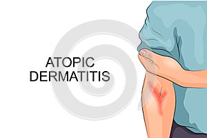 Atopic dermatitis. Allergy photo