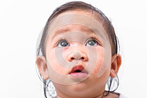 Atopic dermatitis on asian baby face