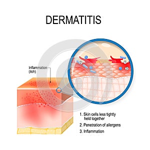 Atopic dermatitis atopic eczema