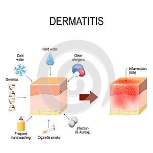 Atopic dermatitis atopic eczema. factors that cause disease. c