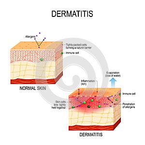 Atopic dermatitis eczema