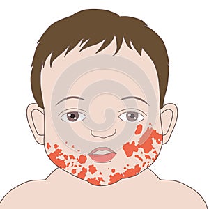 Atopic dermatitis eczema or allergy diseases on cheeks baby face, illustration on white background