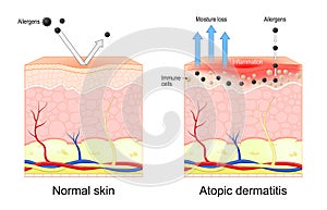 Atopic dermatitis. Eczema