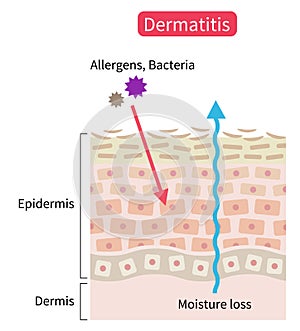 Atopic dermatitis eczema dry skin disrupt moisture barrier that allows penetrate external stimuli. Healthy skin care concept