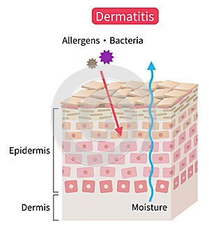 Atopic dermatitis eczema dry skin disrupt moisture barrier that allows penetrate external stimuli. Healthy skin care concept