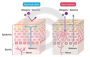 Atopic dermatitis eczema and normal skin cell layer illustration. Healthy skin care concept