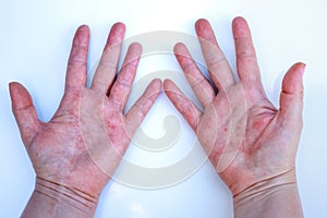 Atopic Dermatitis, Red hands, Dermatological problem, Female hands, Allergy and itching, Minimal concept, White background