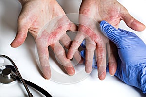 Atopic dermatitis. Red, itchy hands with blisters seen by a dermatologist wearing rubber gloves