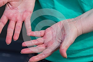 Atopic dermatitis, The woman looks at red and chapped hands with severe allergies