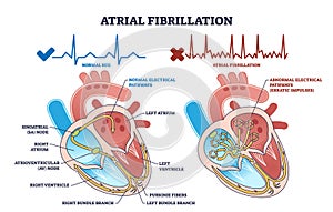 Atrial fibrillation as abnormal heart beat frequency disease outline diagram