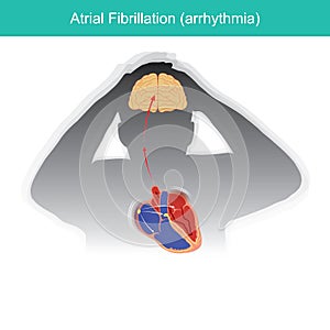 Atrial Fibrillation. Patients condition in which the electrical signals in heart malfunctioning or causing a short circuit in