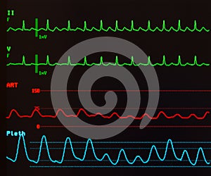 Atrial Flutter with Variable Conduction