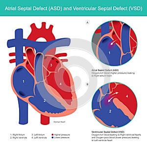 Atrial Septal Defect ASD and Ventricular Septal Defect VSD. Abnormal of the heart atrial and heart ventricle photo