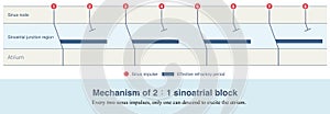 2 to 1 sinoatrial block