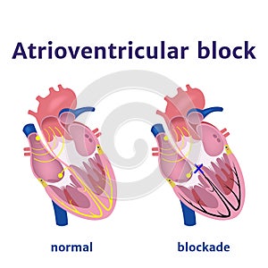Atrioventricular block. Violation of the electrical signal in the heart.