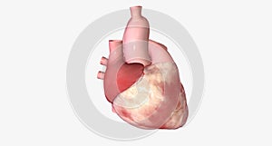 The Atrioventricular Nodal Reentry Tachycardia photo