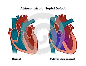 Atrioventricular septal defect. Illustration of the congenital heart anomaly