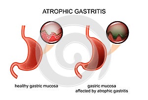 Atrophic gastritis. inflammation photo
