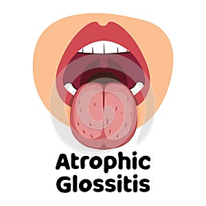 Atrophic Glossitis vector illustration