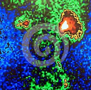 Atrophic kidney nuclear scan