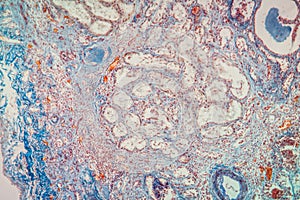 Atrophy kidney tissue