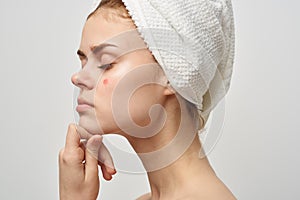 attractive woman with towel on head naked shoulders pimples on face acne skin care