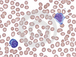 Cytomegalovirus infection. Peripheral blood smear. photo