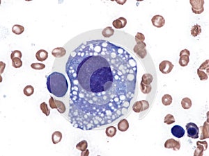 Atypical megakaryocyte in a case of myelodysplastic syndrome. photo