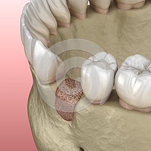 Augmentation Surgery - Adding new bone. illustration photo