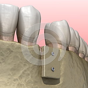 Augmentation Surgery - Bone transplantation, preparing for implantation. 3D illustration