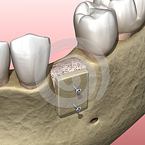 Augmentation Surgery - Bone transplantation, preparing for implantation. 3D illustration