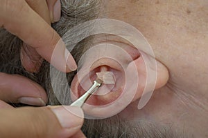 Auricular Seed Treatment