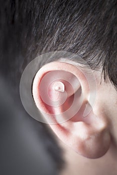 Auriculartherapy ear seed treatment