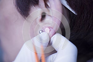 Auriculartherapy ear seed treatment