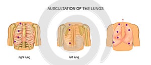 Auscultation of the lungs