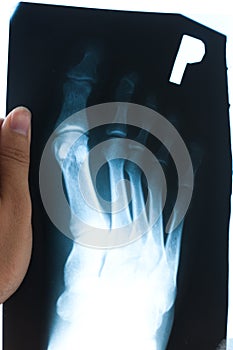 Authentic x-ray of foot