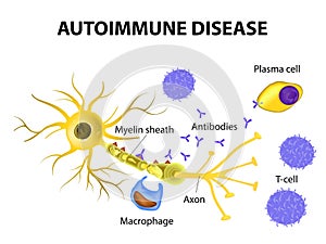 Autoimmune Disease. The mechanisms of neuronal damage in multiple sclerosis