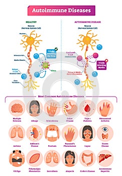 Autoimmune diseases vector illustration. Various illness collection set.