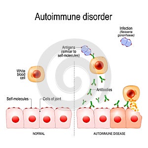 Autoimmune disorders. Antigens of bacterium Neisseria gonorrhoeae are similar to self-molecules of healthy joint cells.