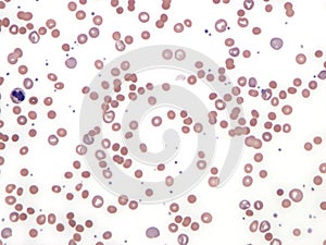 Autoimmune hemolytic anemia.