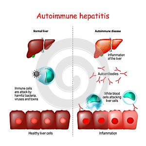 Autoimmune hepatitis