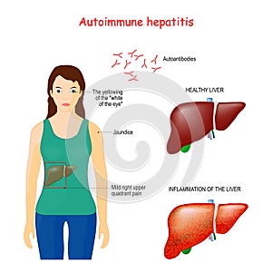 Autoimmune hepatitis. autoimmune disease