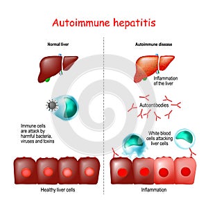 Autoimmune hepatitis photo