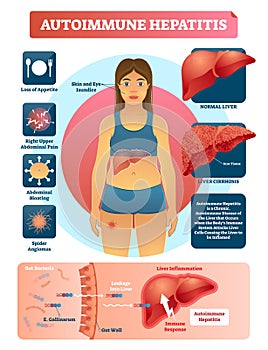 Autoimmune hepatitis vector illustration. Labeled diagram with disease photo
