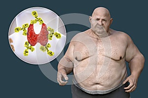 Autoimmune thyroiditis in obesity, conceptual 3D illustration showing an overweight patient and thyroid gland attacked by