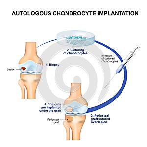 Autologous Chondrocyte Implantation photo