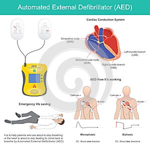 Automated External Defibrillator.